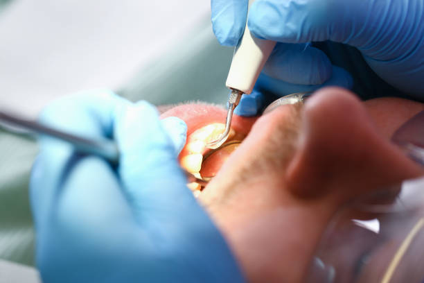 Best Emergency Treatment for Dental Infections or Abscesses in Grove City, PA
