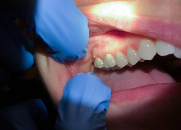 Best Emergency Gum Treatment in Grove City, PA